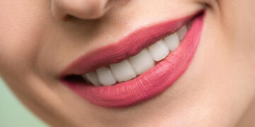 A Hollywood smile with dental esthetics: the possibilities of modern dental medicine Teaser